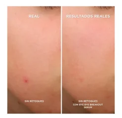 Sale Bye Bye Breakout Serums